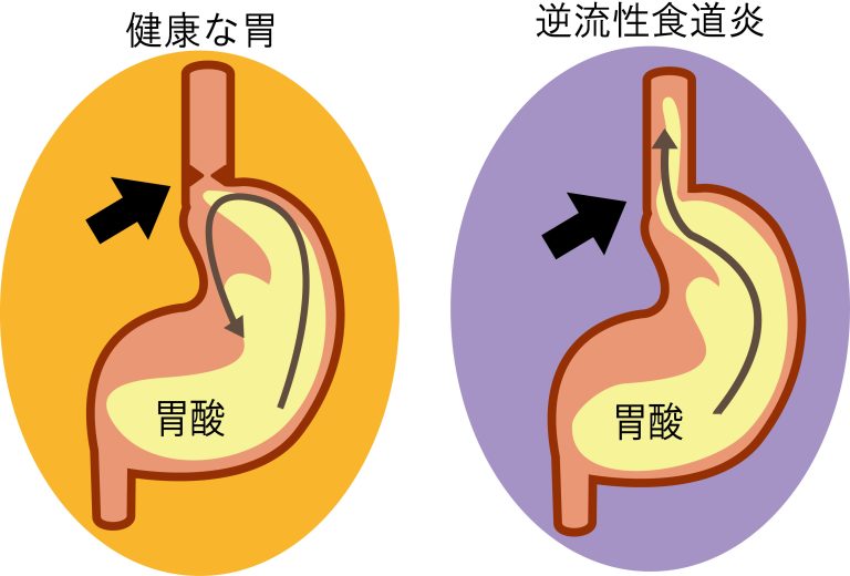 逆流性食道炎の図　（正常の胃との比較）